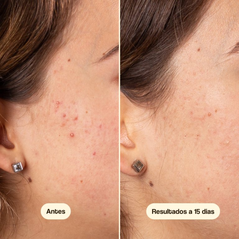 Azelaic Radiance Face  Serum 50ml -Freshly